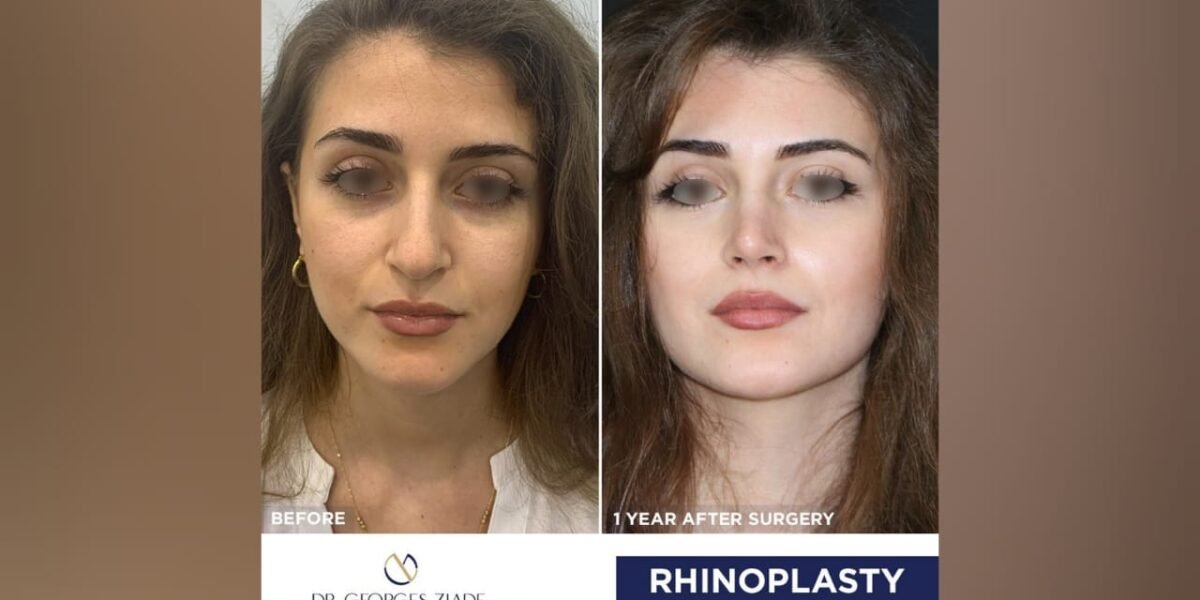 عملية تجميل الأنف/Rhinoplasty.. مع جورج زيادة